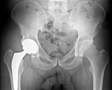Artroplastias