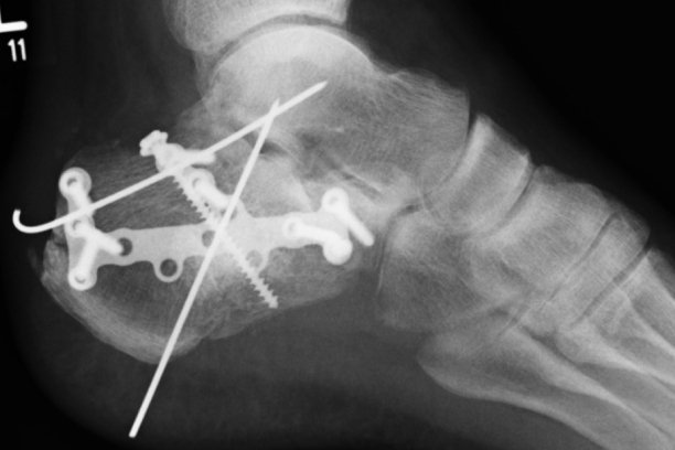 Cirugía de Fracturas y Luxaciones
