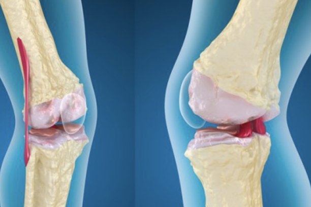 Cirugía de Lesiones de Cartílago Articular