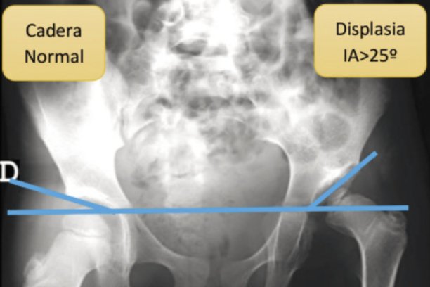 Tratamiento de displasia del desarrollo de la cadera