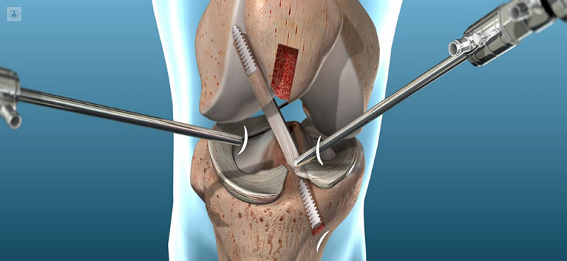 Ruptura de Ligamento cruzado
